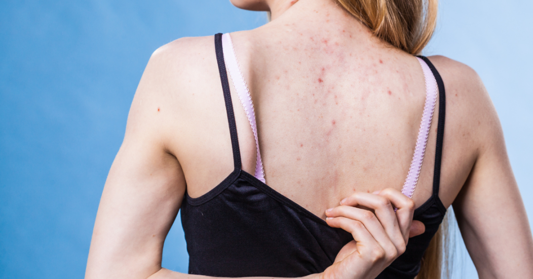 Woman with visible body acne on her chest and shoulders, looking concerned.