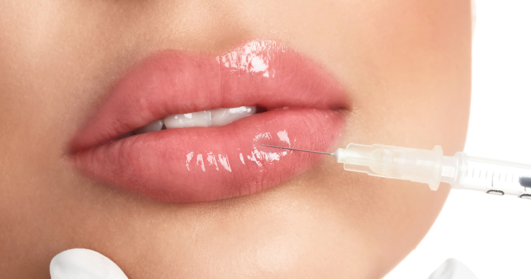 Close-up of a woman’s lips as a healthcare professional injects dermal filler, showing precise treatment application.