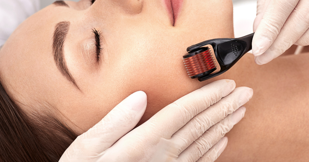 At-Home Dermarollers or Professional Microneedling: Which Works Best? 1 Patient gently rolling a dermaroller across the cheek during a skincare treatment.