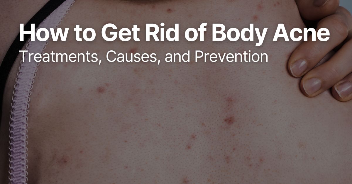 Woman examining her body acne, showing signs of skin irritation and breakouts.