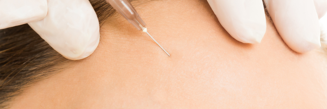 Aesthetic practitioner injecting Bocouture into a patient's frontalis muscle to treat horizontal forehead lines