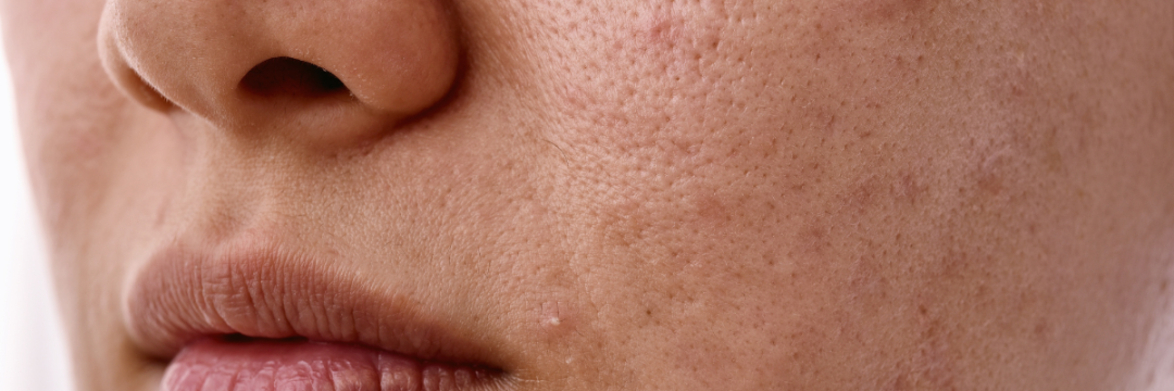 Close-up of irritated facial skin with redness and visible texture