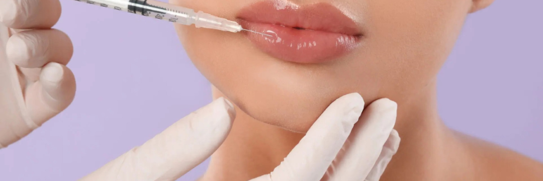 Patient getting lip filler.