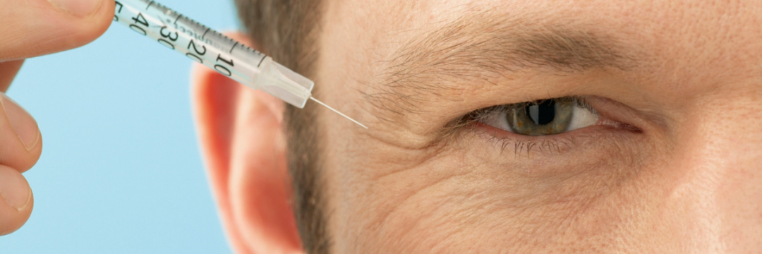 Botulinum Toxin Injections: Where to Buy Botox Online? 2 A man receiving a Botox injection into his forehead to reduce wrinkles.