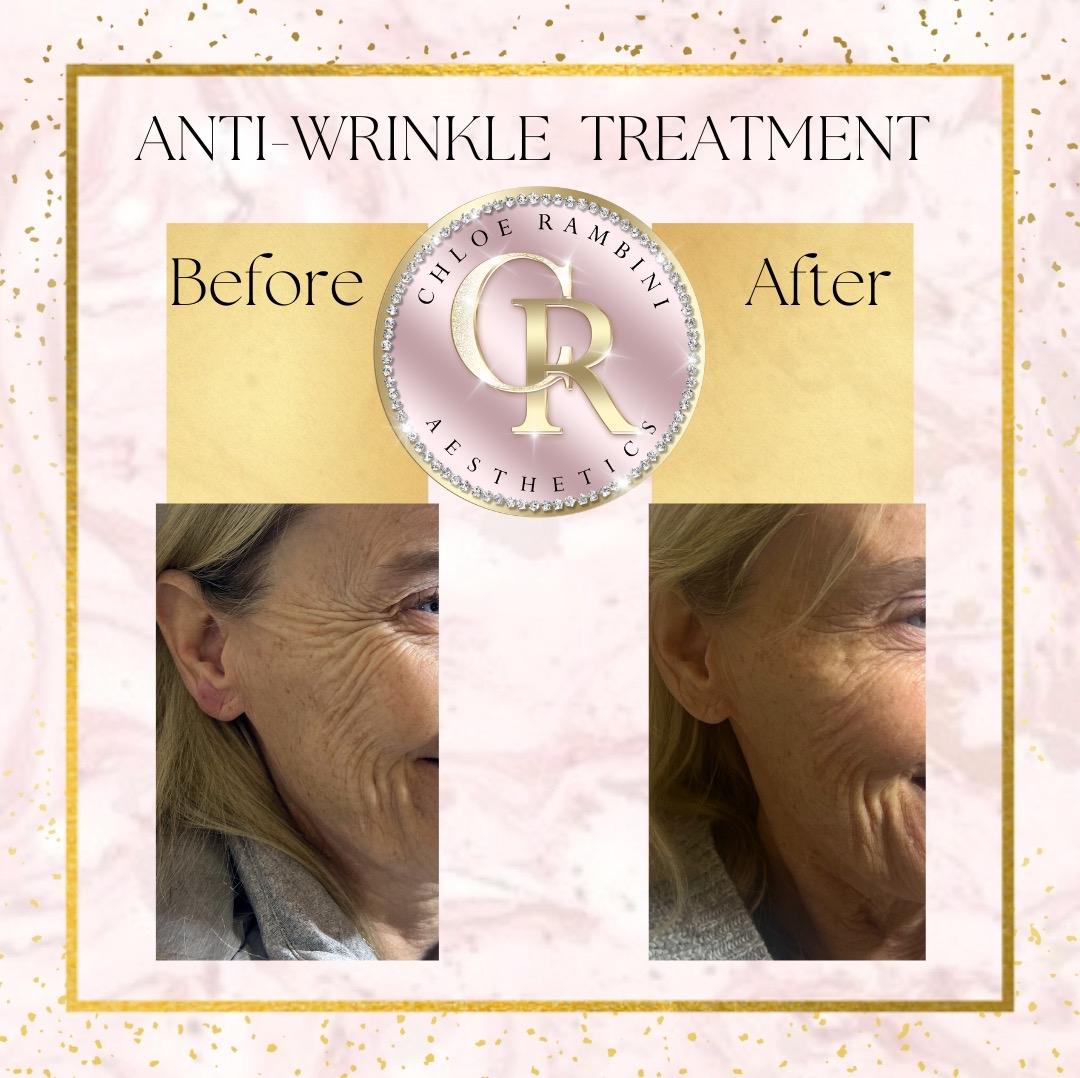 Chloe Rambini ~ Aesthetics Redditch image 3