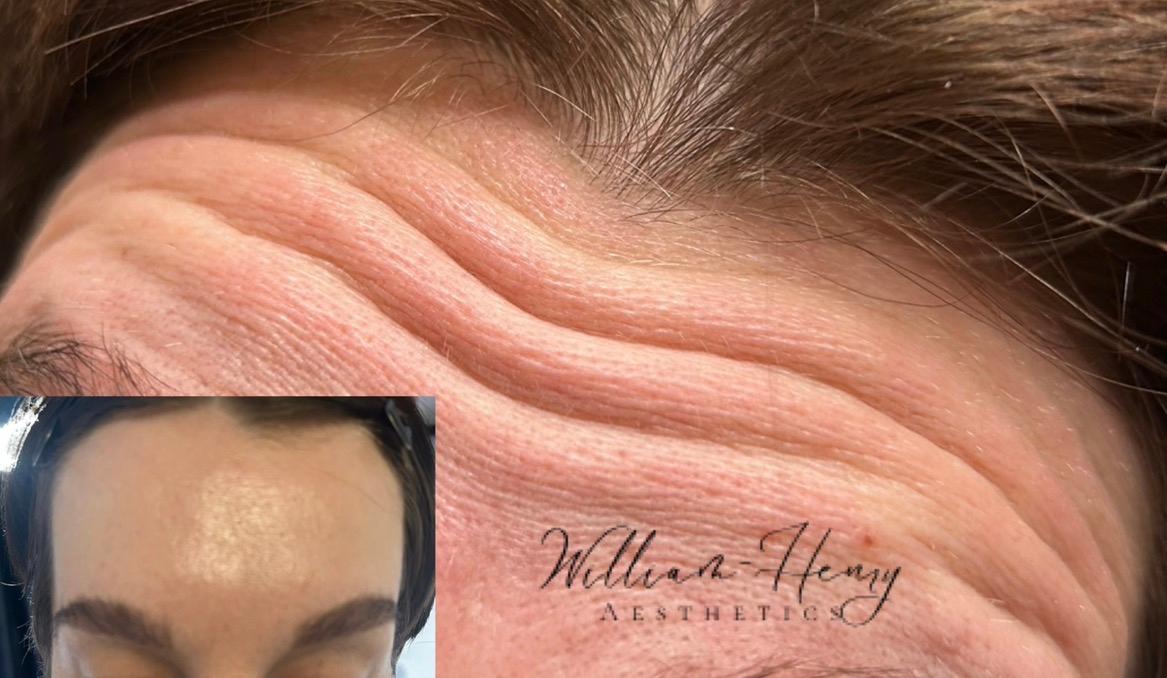 Botox image 2
