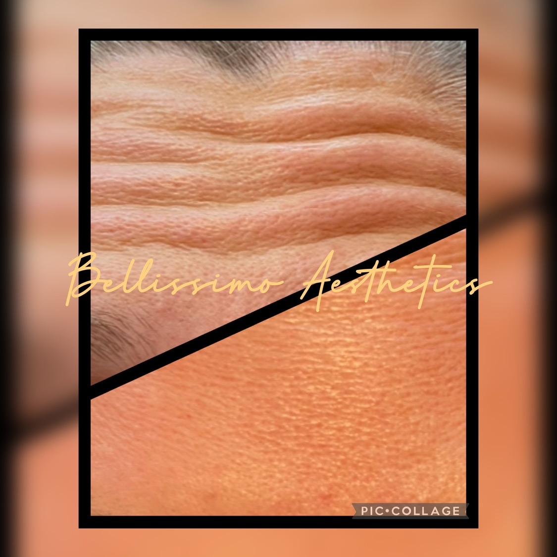 Botox image 3