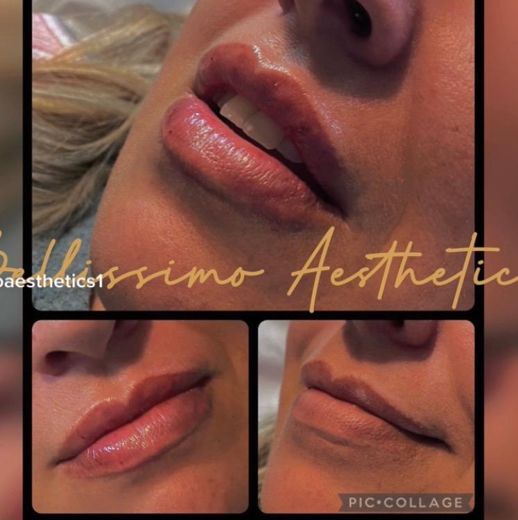 Botox image 2
