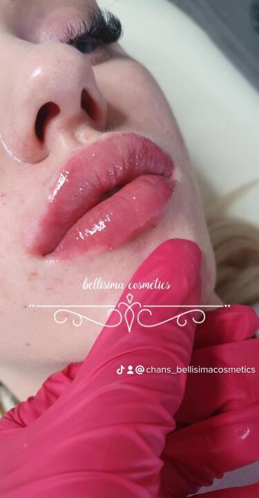 Lip filler image 2