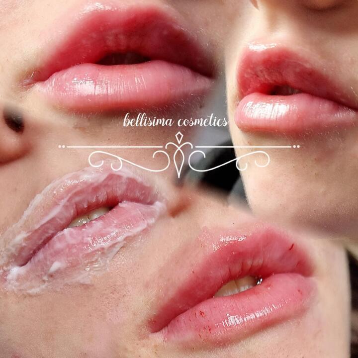Lip filler image 3