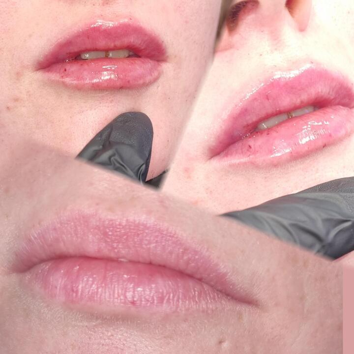 Lip filler image 1