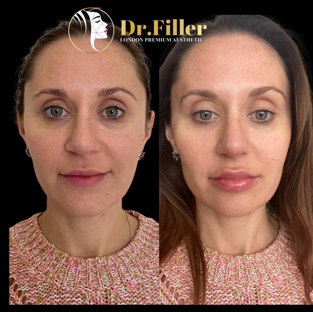 Dr Filler London Mayfair  image 3