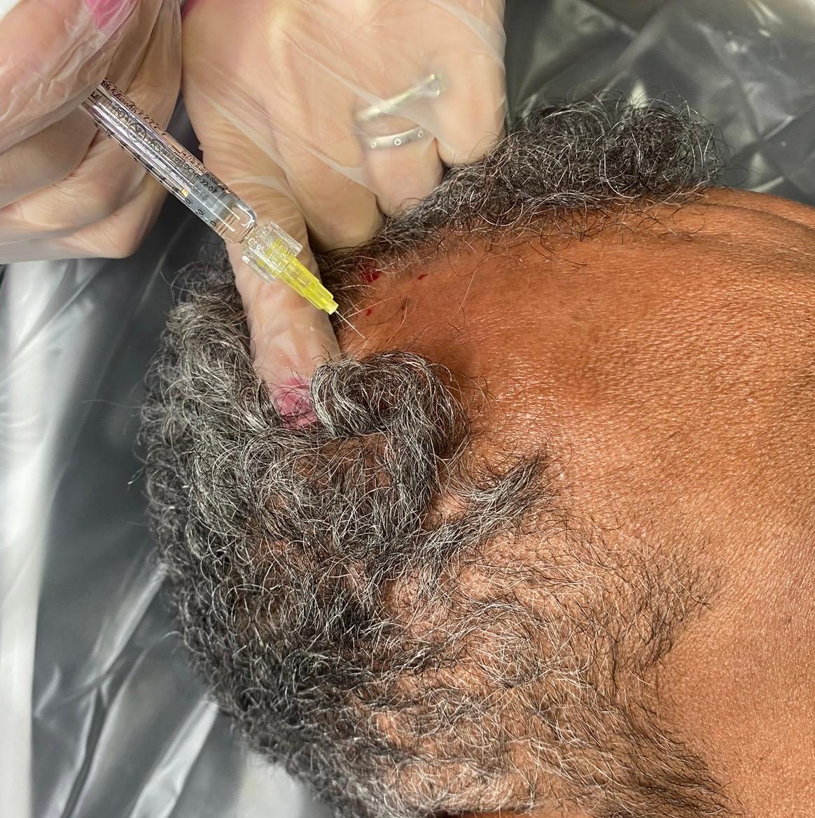 Hair Restoration image 2