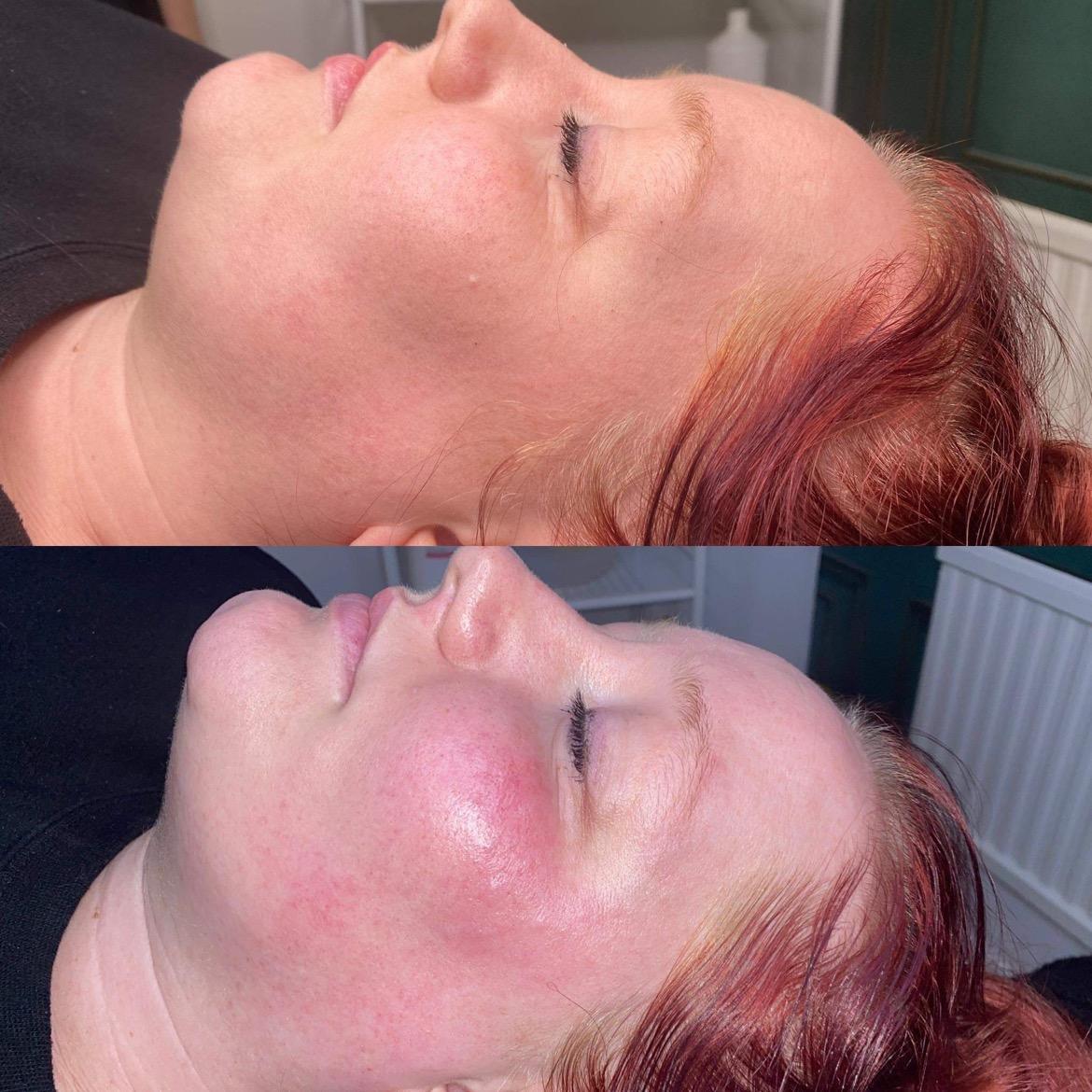 Dermaplane image 3