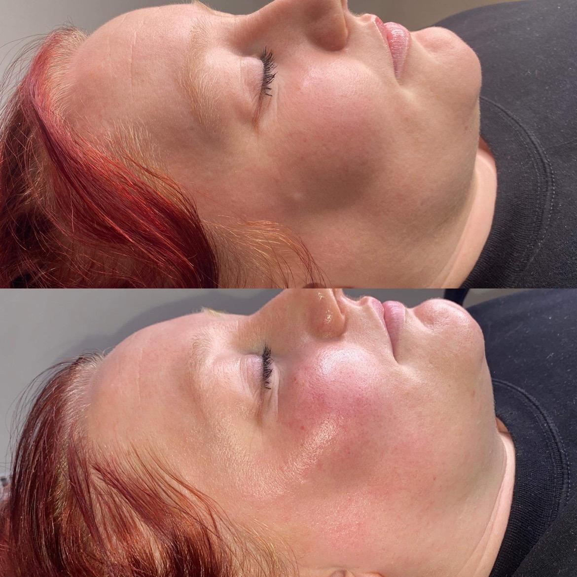 Dermaplane image 2