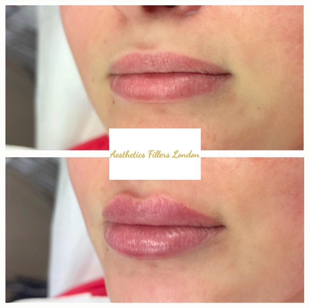 Aesthetics Fillers London image 2
