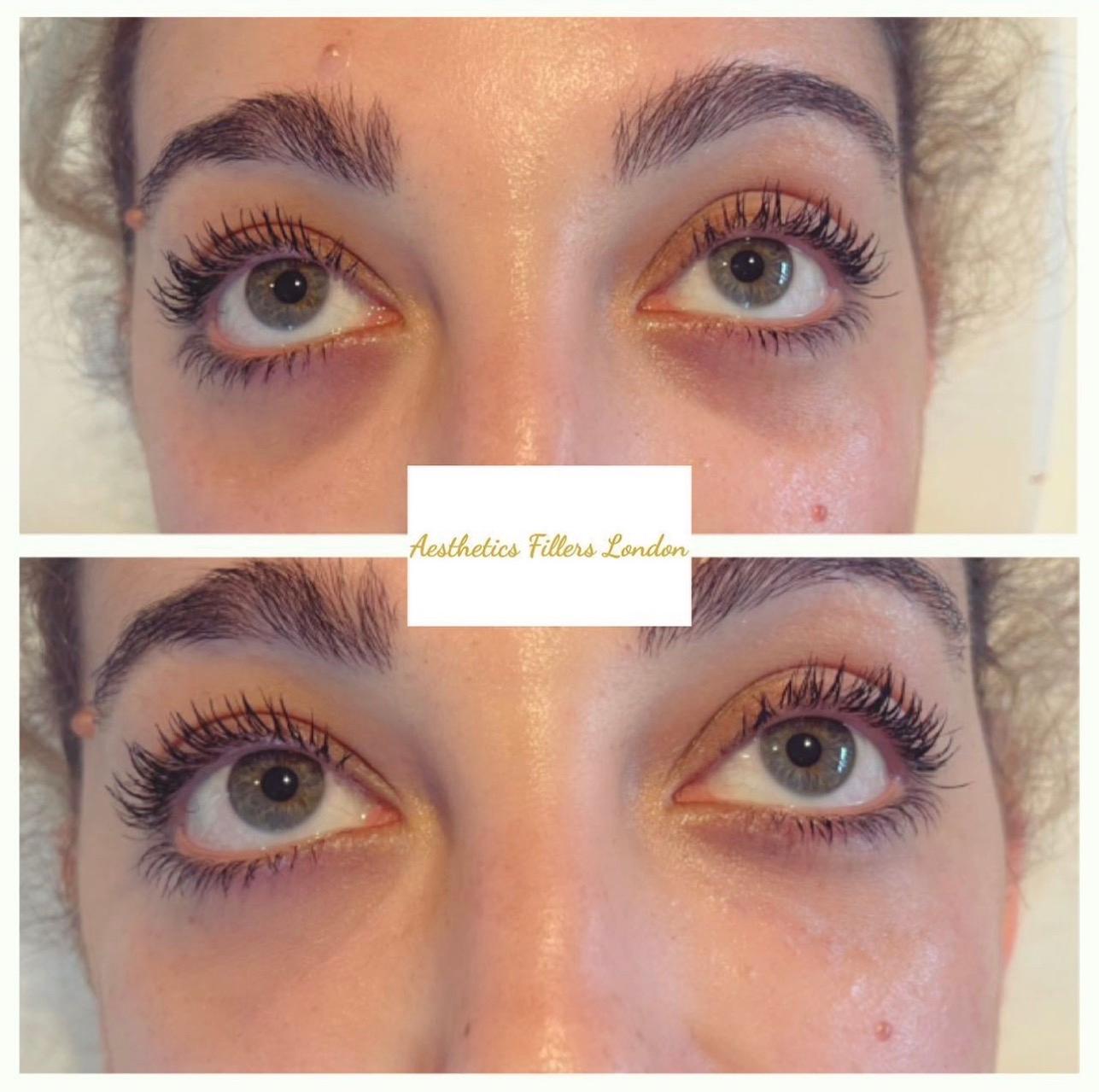 Aesthetics Fillers London image 3