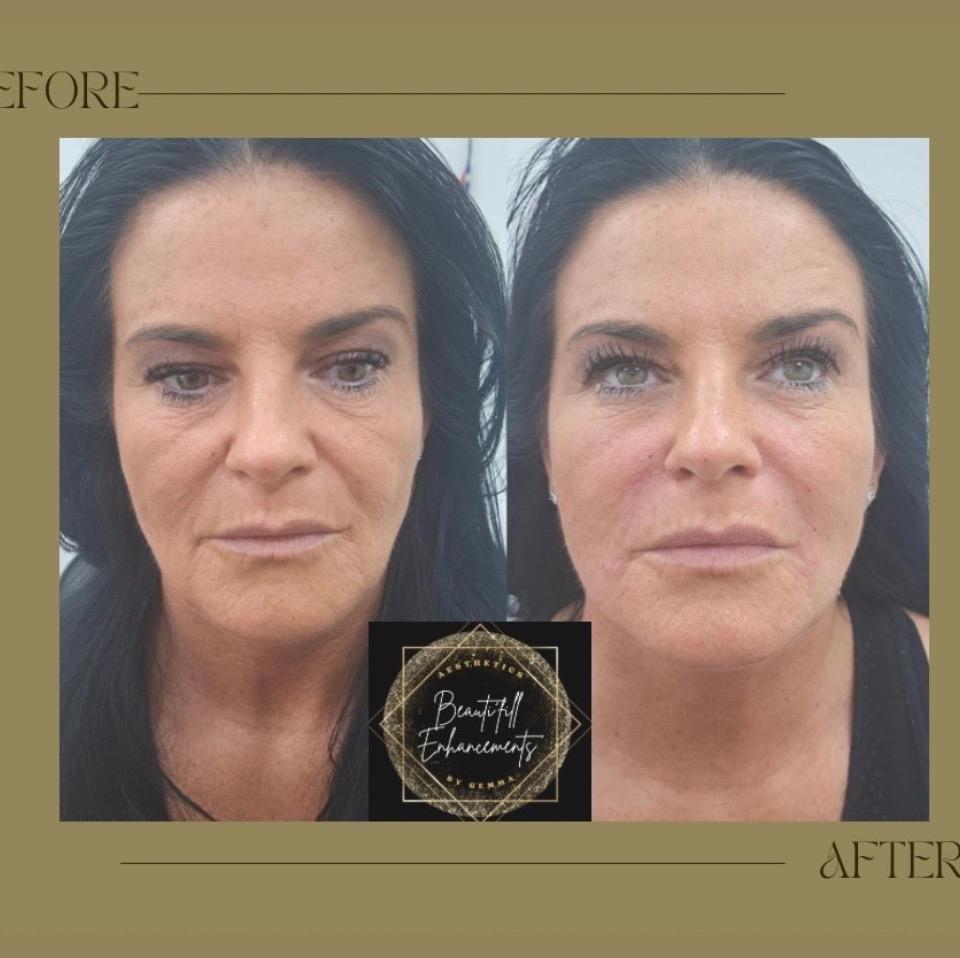 Beautifill Enhancements image 1