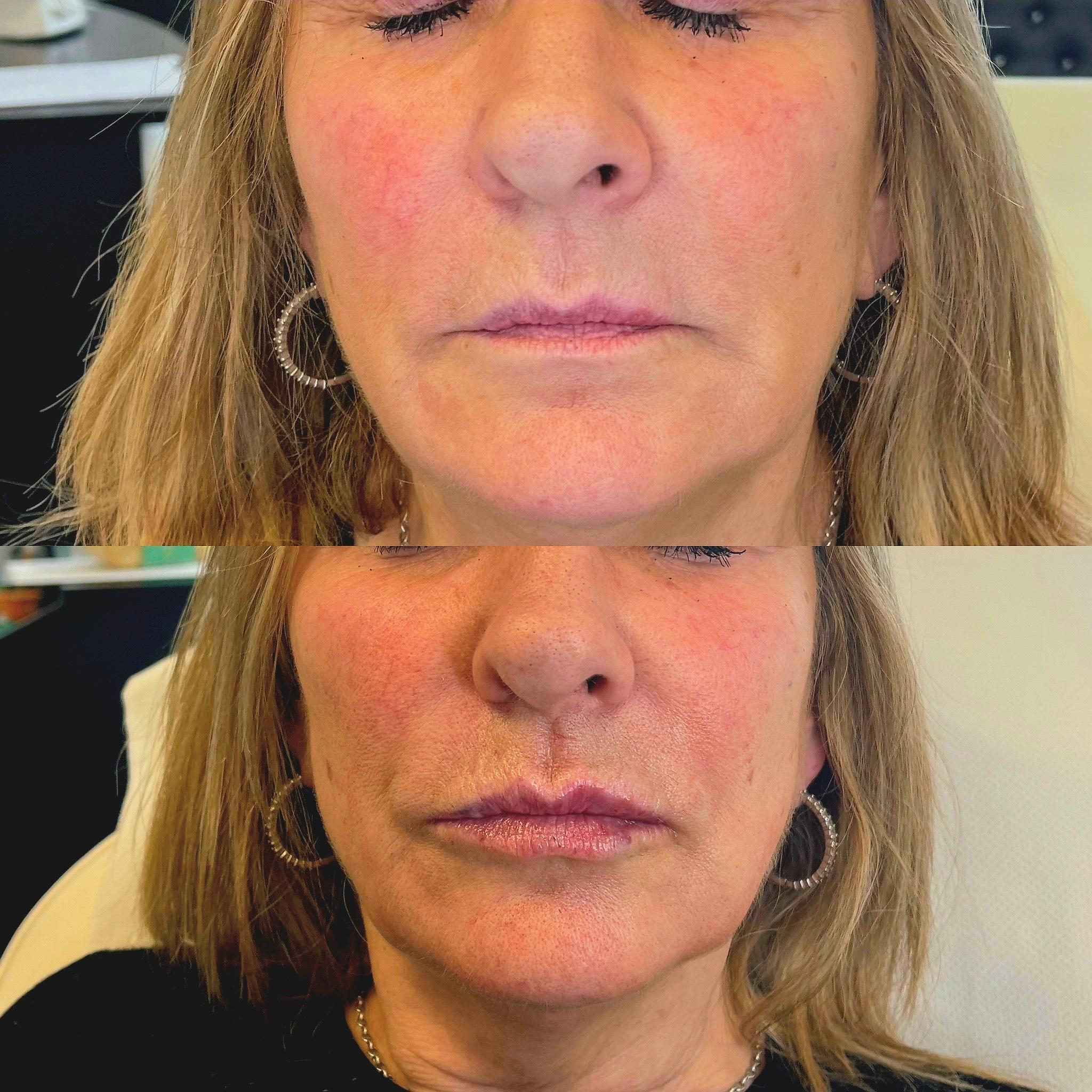 Lip stop  image 2