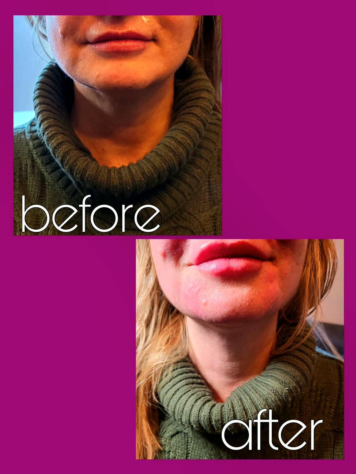 Lip stop  image 1