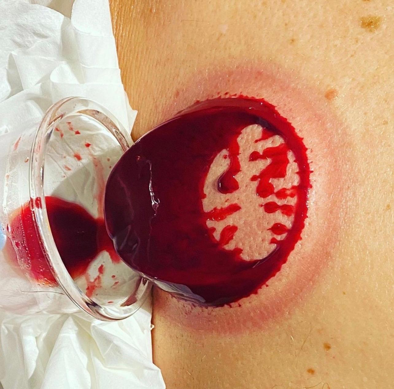 Hijama Detox Therapy image 2