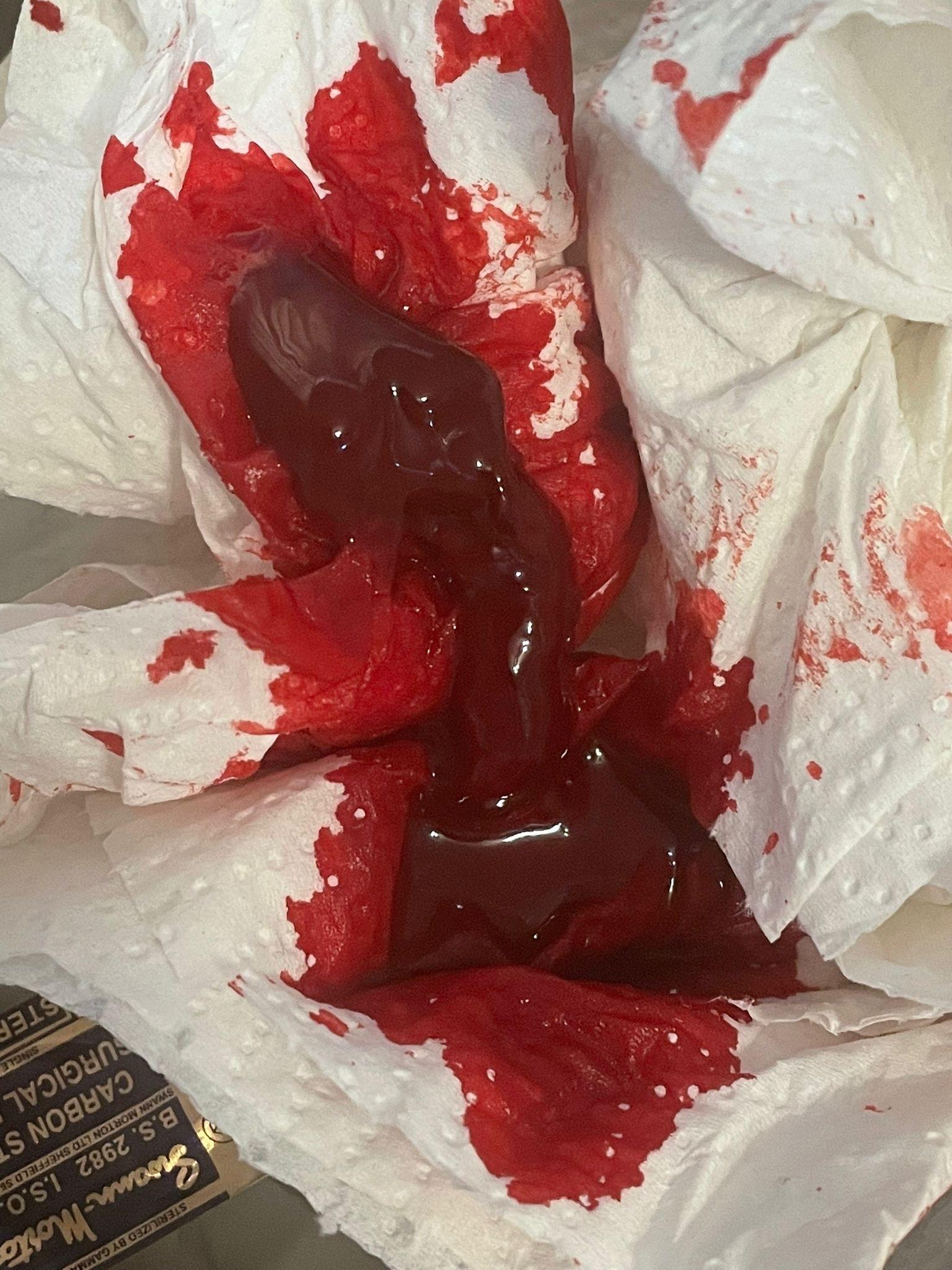 Hijama Detox Therapy image 1