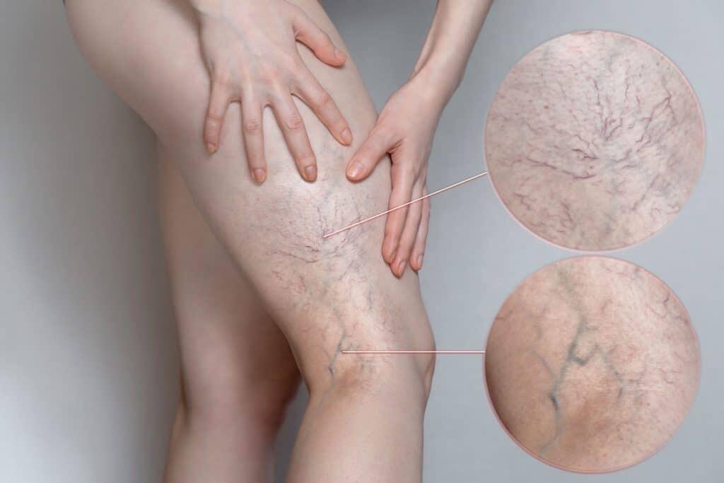 Microsclerotherapy image 1