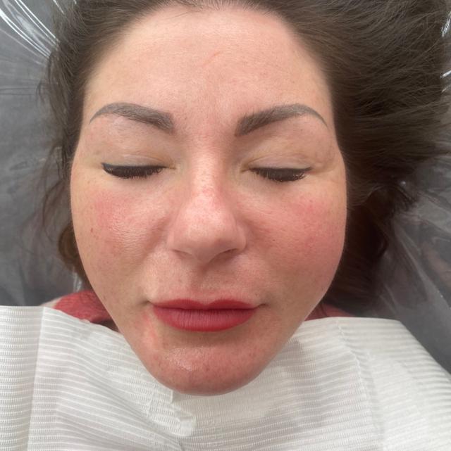 after Thread Lift