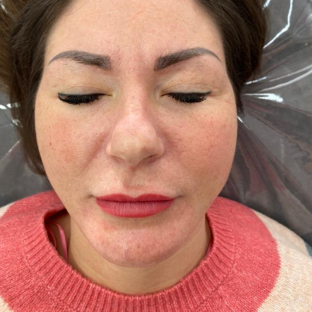 before Thread Lift
