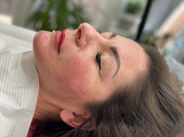 look after Thread Lift treatment