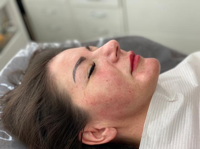 after Thread Lift treatment