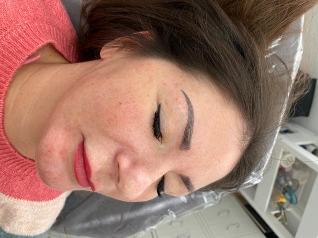 before Thread Lift treatment