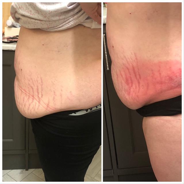 after Cryolipolysis treatment
