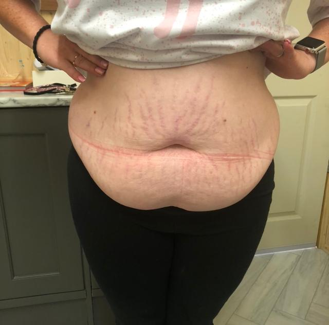 before Cryolipolysis treatment