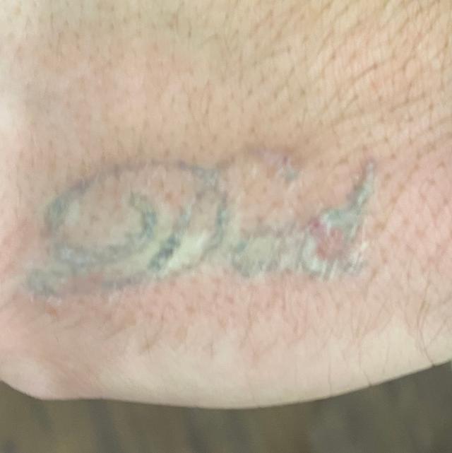 after Laser Tattoo Removal