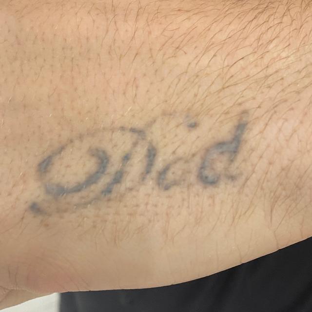 before Laser Tattoo Removal