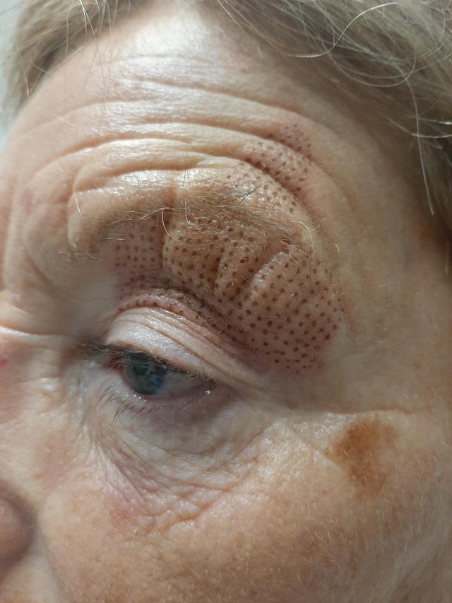 after Fibroblast treatment