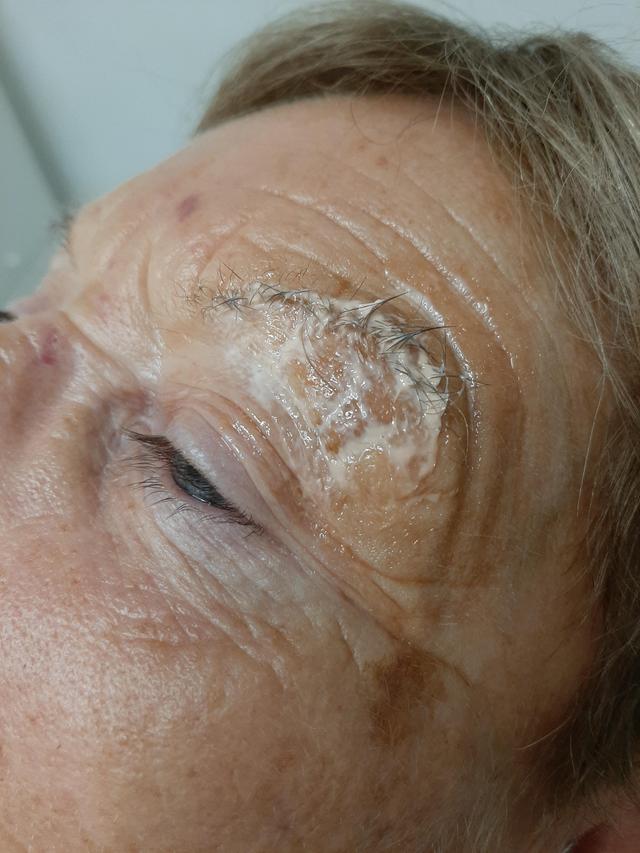 before Fibroblast treatment