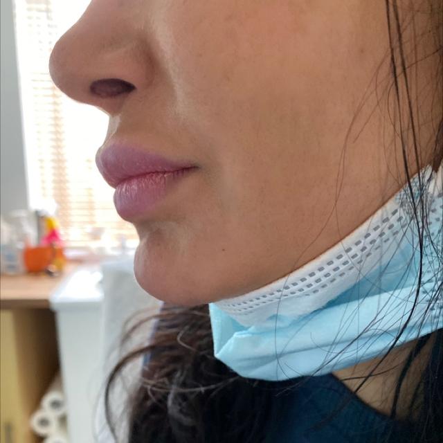 after Kenalog Injection treatment