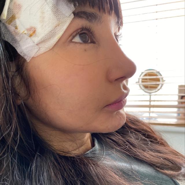 before Kenalog Injection treatment