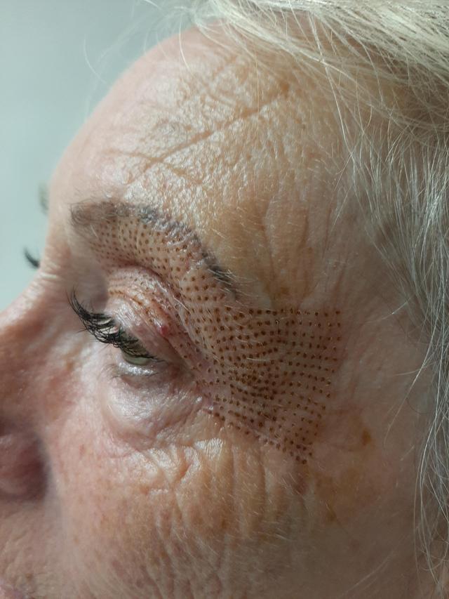 after Fibroblast