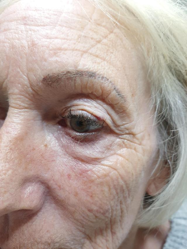 look before Fibroblast treatment