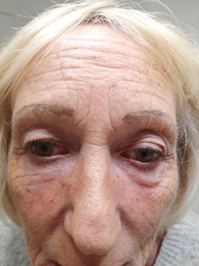 before Fibroblast