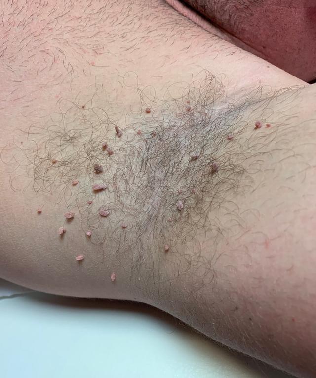 before Skin Tag Removal treatment