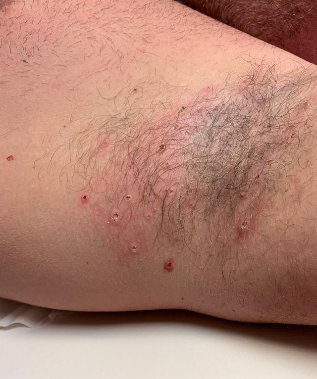after Skin Tag Removal treatment