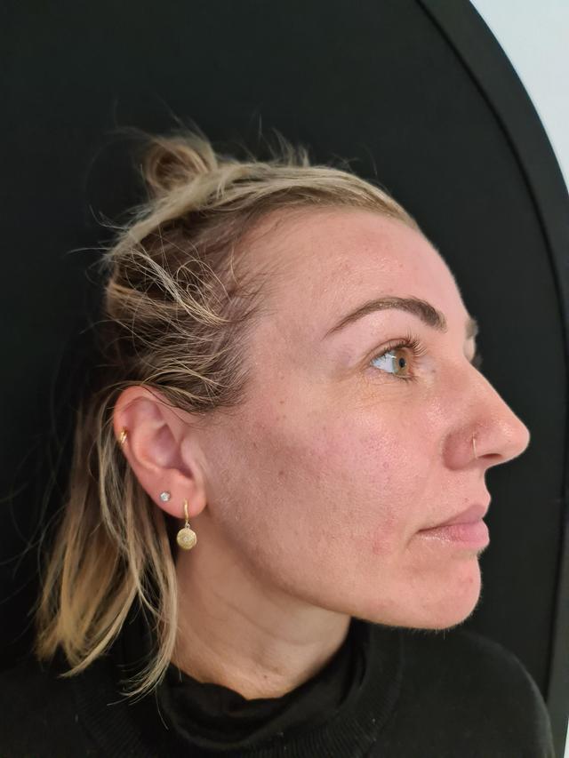 look after Face Lift treatment