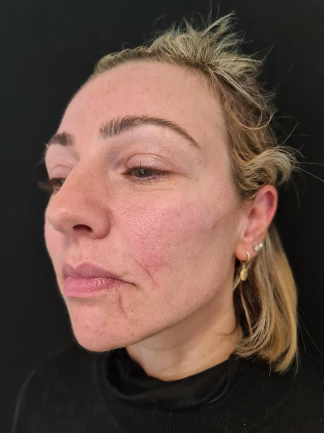 after Face Lift