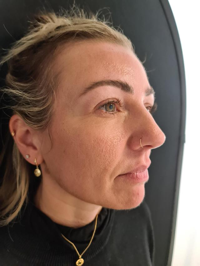 look before Face Lift treatment