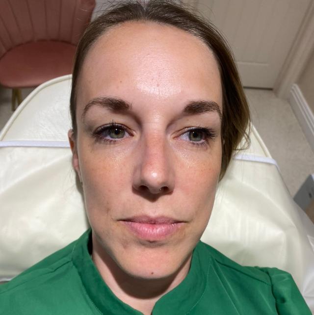 look before PRF treatment