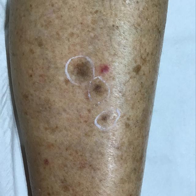 before Cryotherapy treatment